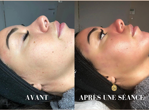 Soin Hydraface à Compiègne avant après