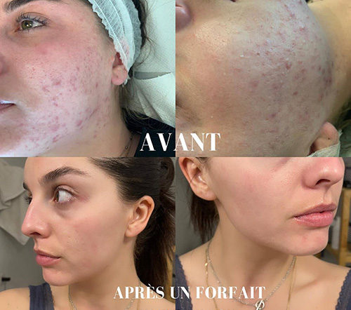 Soin Hydra Spa Face à Compiègne avant après